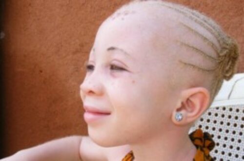 Article : Albinos d’Afrique, meurtres et sorcellerie