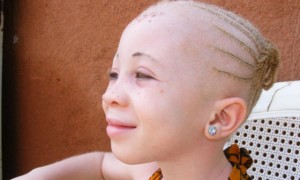 Article : Albinos d’Afrique, meurtres et sorcellerie